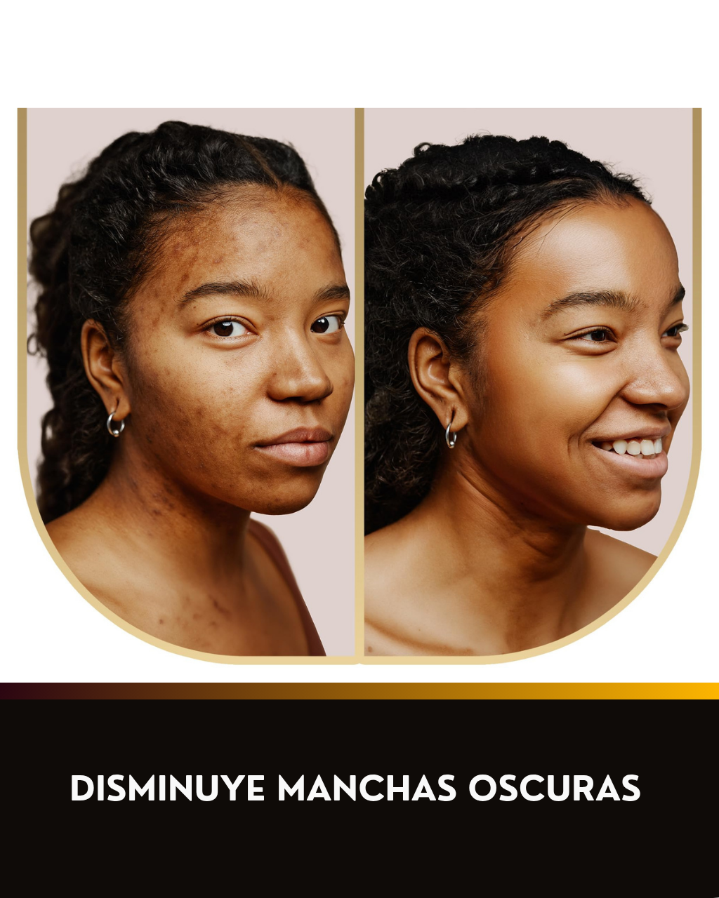 Jabón Despigmentante Con Ácido Kójico, Cúrcuma y Retinol